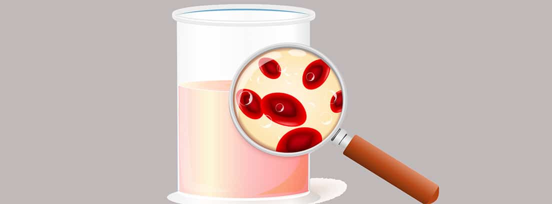 Hematuria, sangre en la orina