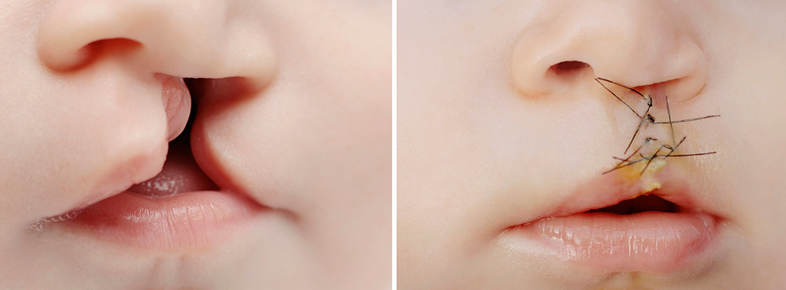 bebé con labio leporino y tratamiento de cirugia