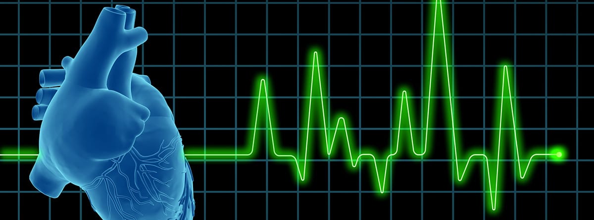 Cierre orejuela: imágen de elcetrocardiográma con un corazón