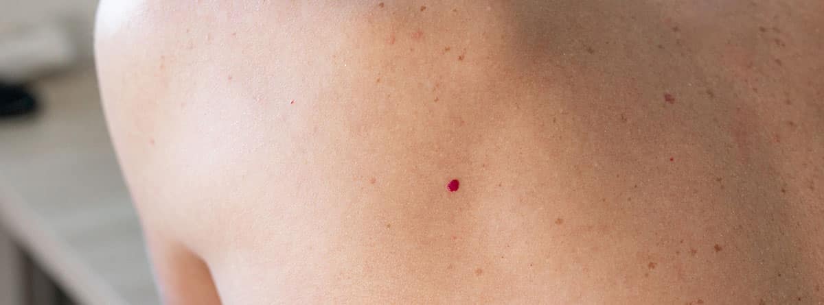 Petequias: espalda de hombre con petequias