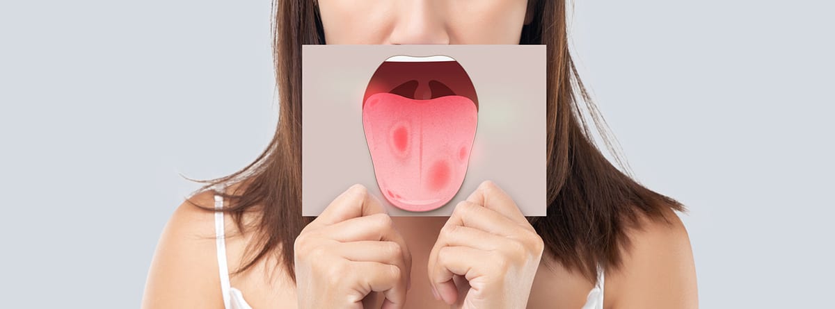 Estomatitis: mujer con la lengua llena de úlceras