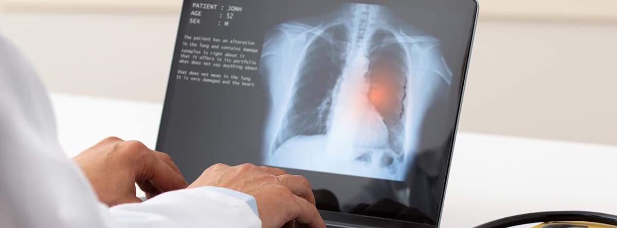 Edema agudo de pulmón: neumólogo con el portátil, visualizando una radiografía de pulmón