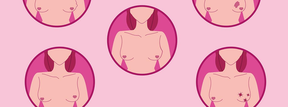 Nódulos mamarios: imagen de nódulos en las mamas