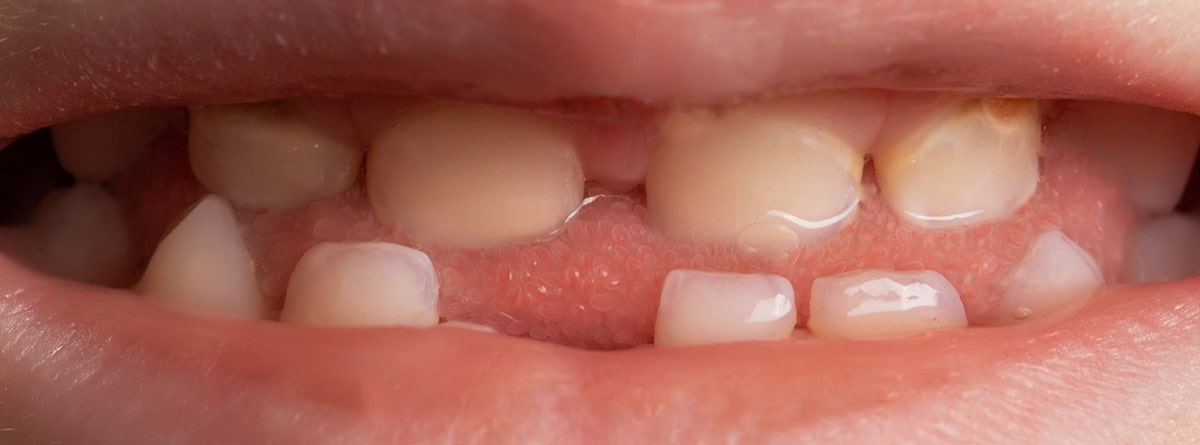 Agenesia dental, tratamiento: La sonrisa de un niño sin un diente en la mandíbula