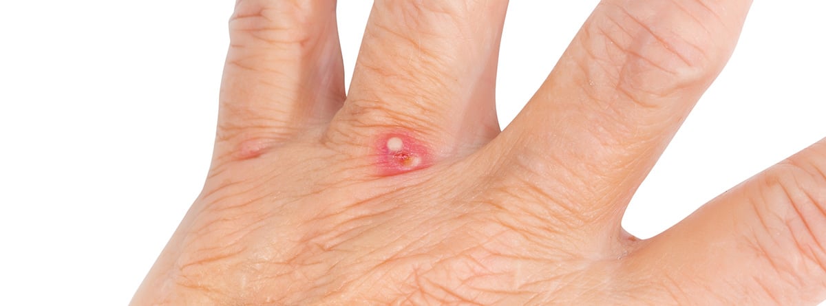 Picadura de hormiga roja: mano con una picadura de hormiga