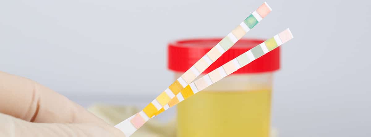 Vaso de recogida con orina y tiras reactivas de orina sobre una mesa de laboratorio