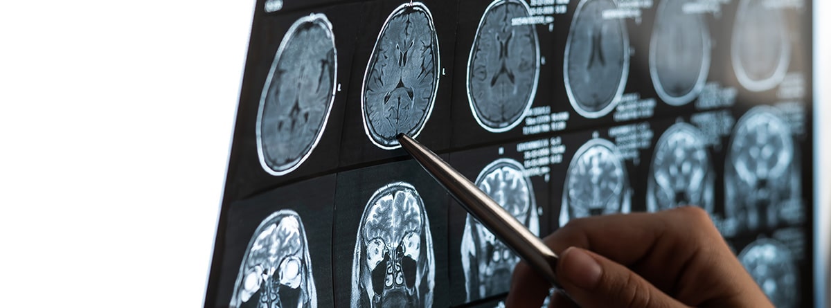 Tomografía del cerebro