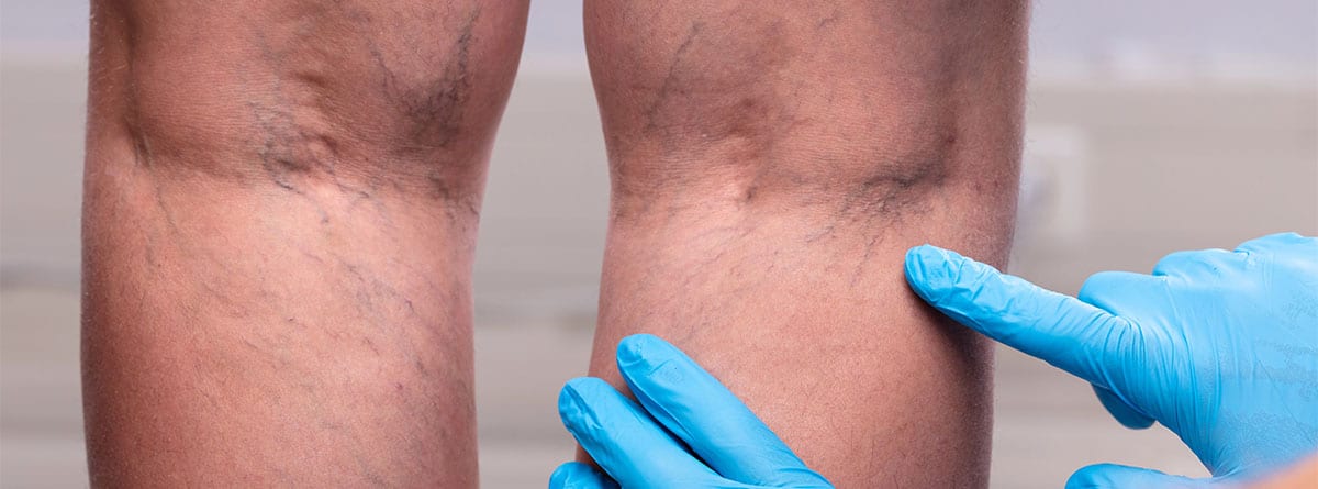 Mujer con trombos en las piernas