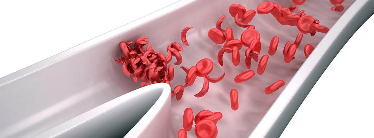 Anémica de células falciformes