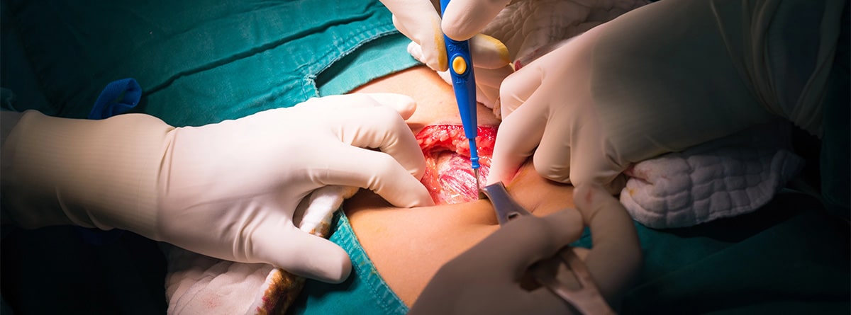 Operación de peritonitis