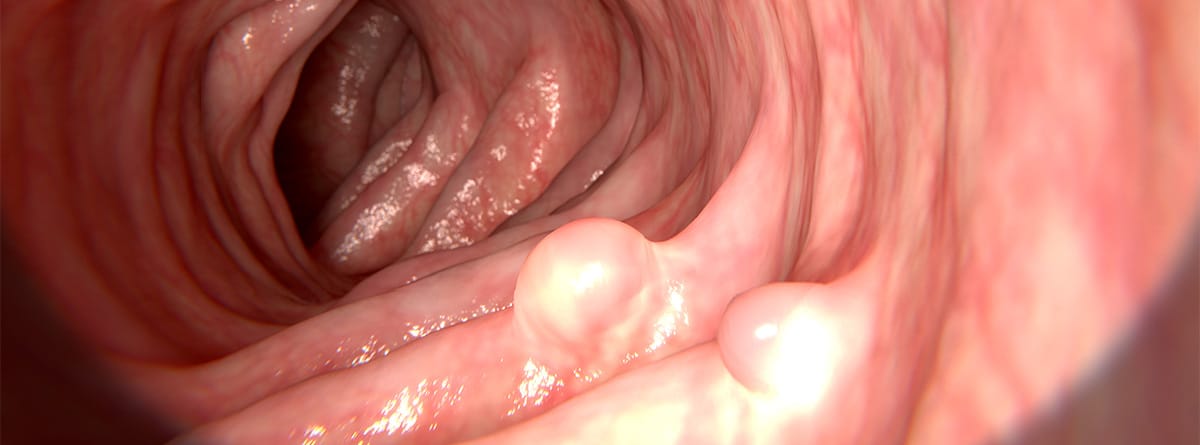 Imagen de colonoscopia