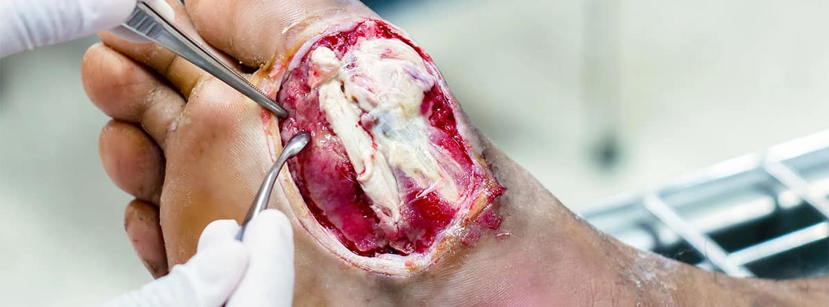 Pie diabético con úlcera