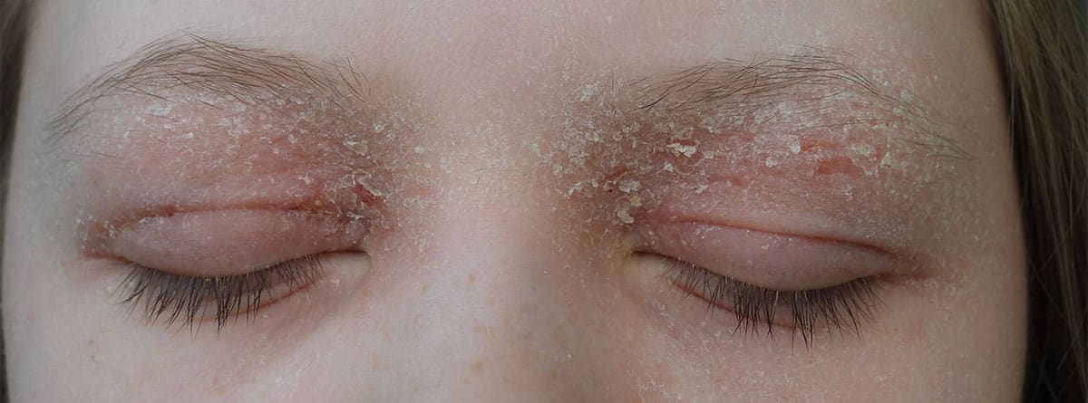 Dermatitis palpebral