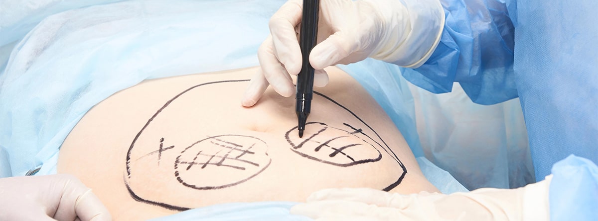 Barriga en un quirófano antes de la liposucción