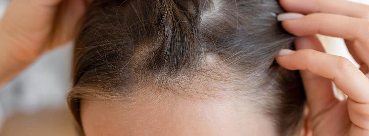 Cuero cabelludo de mujer con calvas