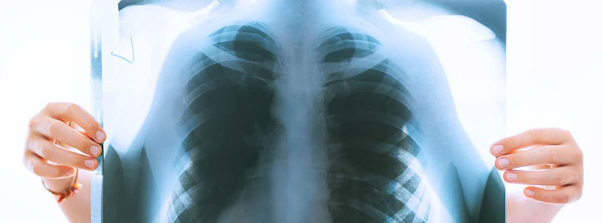 Radiografía de tórax