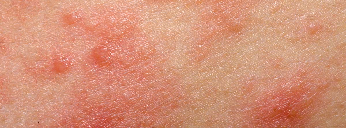Piel con dermatitis