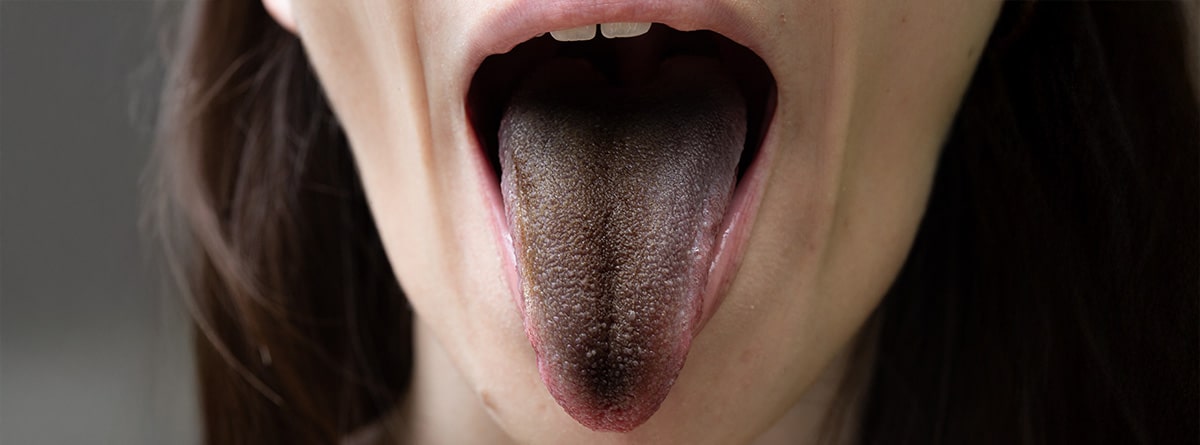 Mujer con lengua vellosa negra
