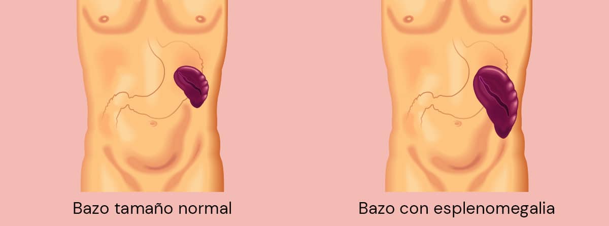 Ilustración de un bazo normal y uno con esplenomegalia