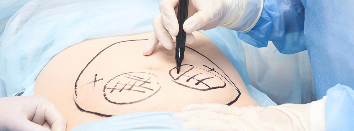 Marcas sobre un estómago antes de una operación