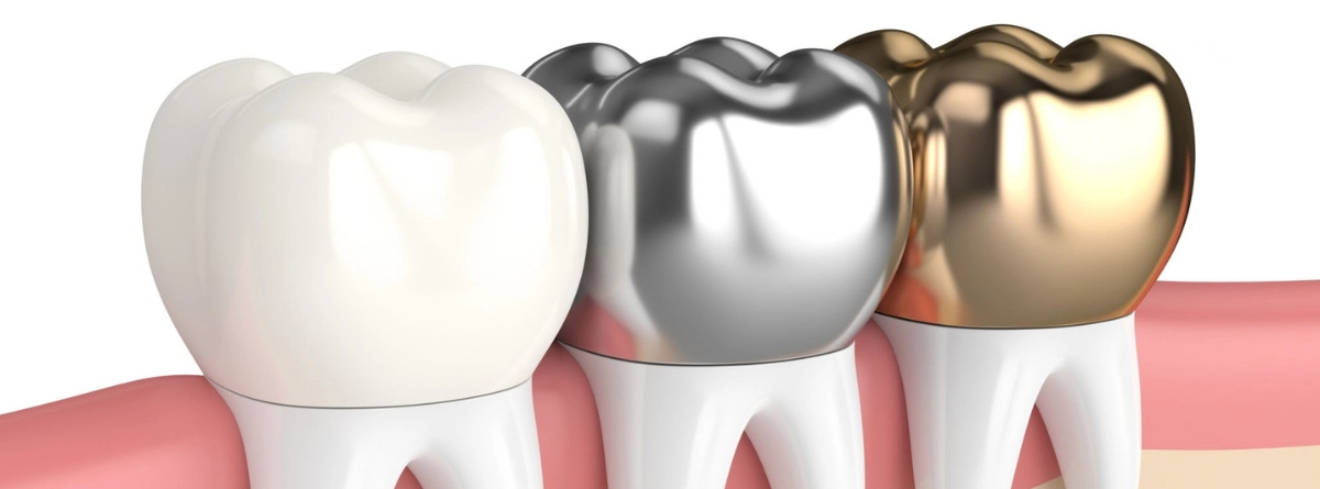 Modelado en 3D de piezas dentales con empastes de composite estético en la cara oclusa