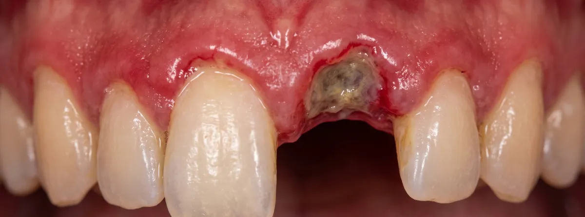 Detalle clinico de gingivitis necrosante aguda con inflamacion en encia y papilas interdentales 
