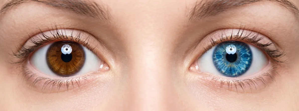 Detalle de heterocromía del iris con un ojo azul brillante y otro castaño, rasgo característico del síndrome de Waardenburg. 